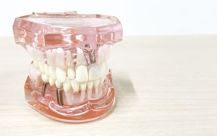 インプラントの噛み合わせが悪いとどんな影響が？…定期的な噛み合わせ