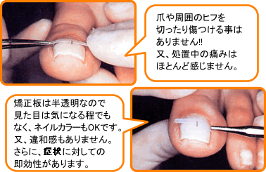 BS/BRACEを選ぶ理由（ワケ）