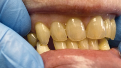 Multidisciplinary approaches to restoring vertical dimension of