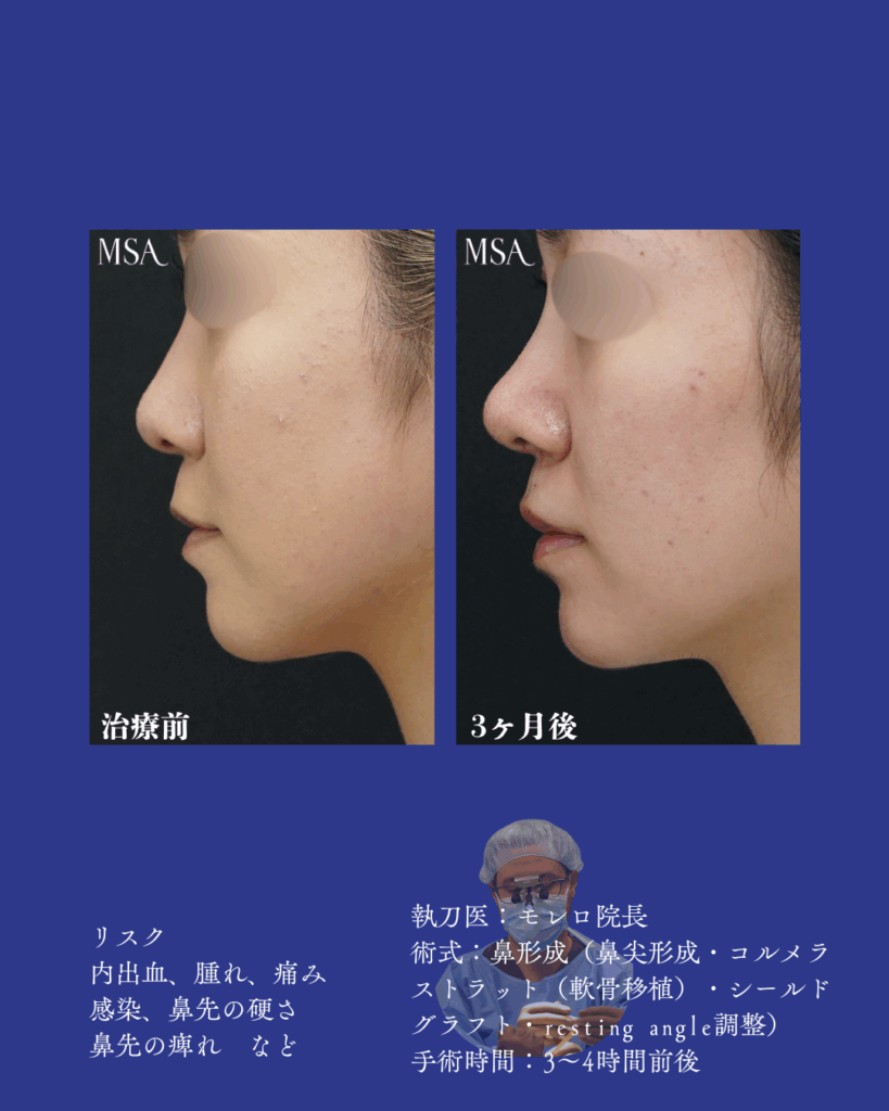 沖縄那覇市美容クリニック | MSA美容外科 – 鼻形成・鼻中隔延長