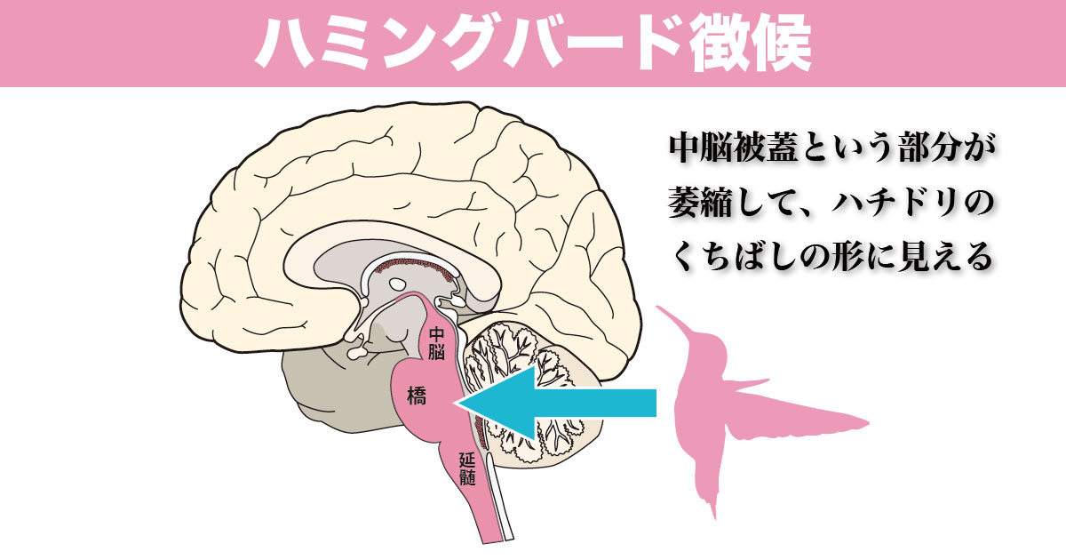 進行性核上性麻痺(PSP)の予後と再生医療の進展|脳梗塞・脊髄損傷後遺症