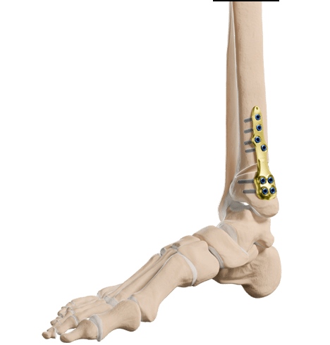 Foot & Ankle. - Newclip Technics