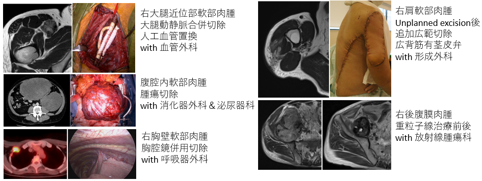 整形外科(骨軟部腫瘍科）｜大阪国際がんセンター