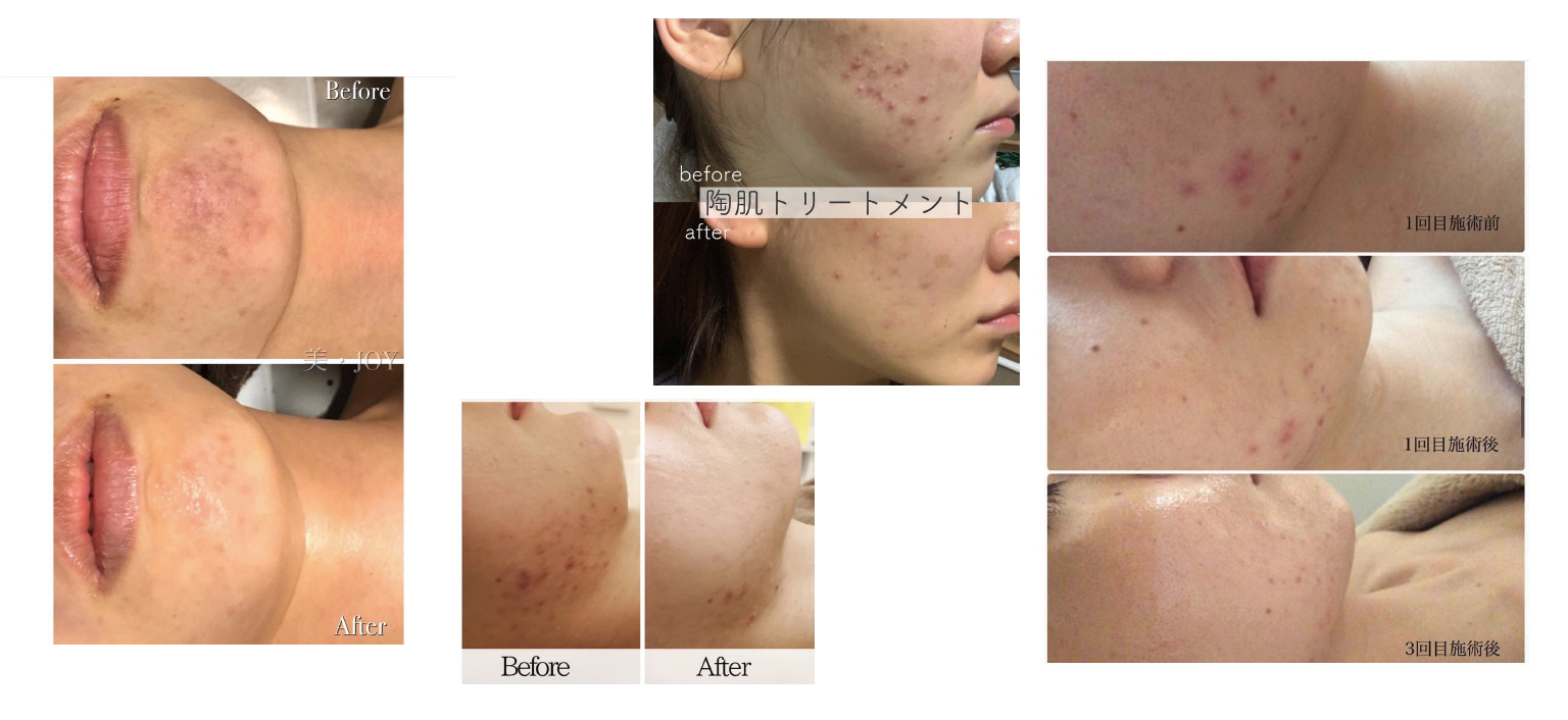 ハーブピーリングは効果ある？特徴とおすすめする理由 - REVIルヴィ