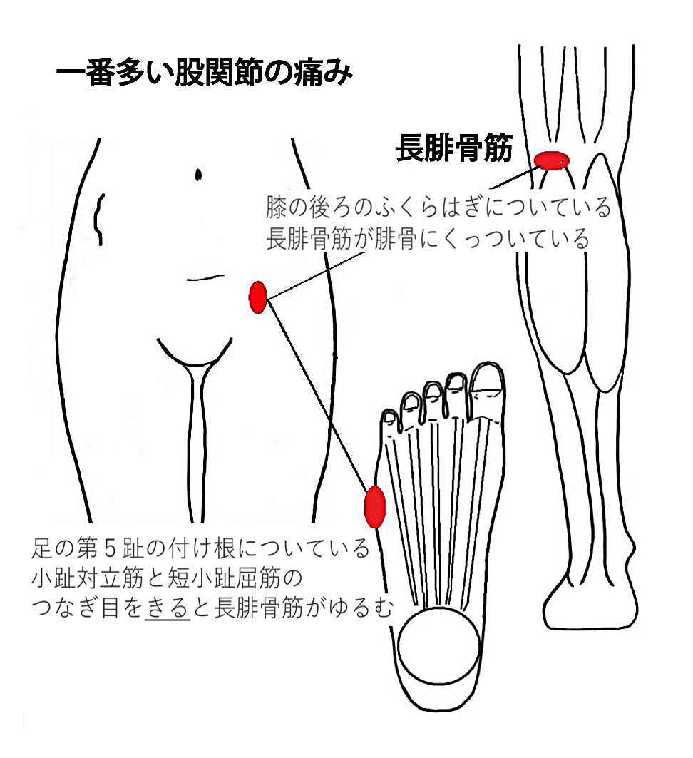 天城流湯治法 股関節痛 リックスマツヤ 天城流マイスター 小松 隆