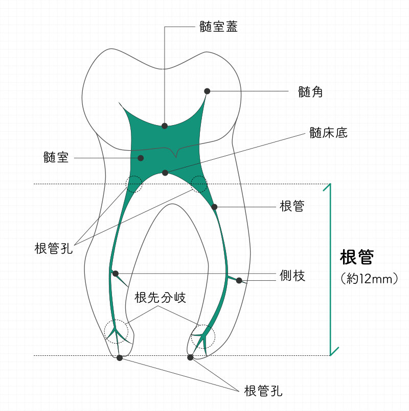 根管治療(歯内療法)の 成功率が低い理由