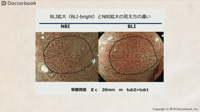 医師出演】NBI・BLIによる胃がんの拡大内視鏡診断とは？ | Doctorbook